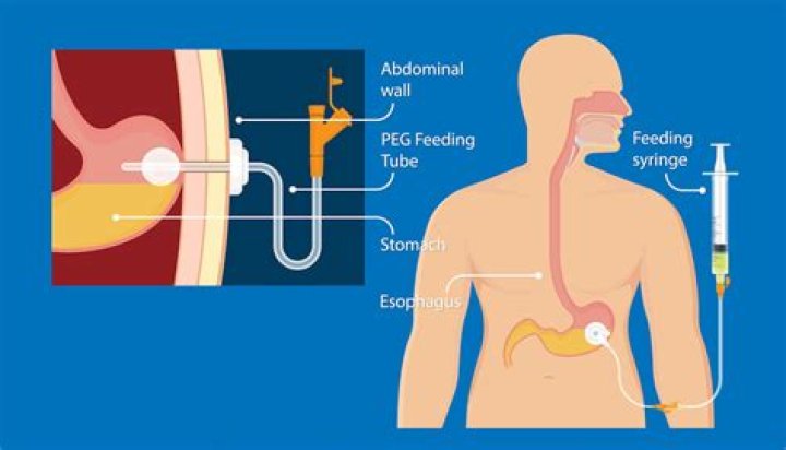 How do you insert a PEG feeding tube
